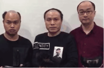 遗传性的头发所在问题 脂溢性脱发