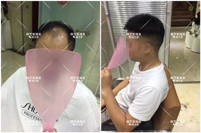 做隐形增发多少钱