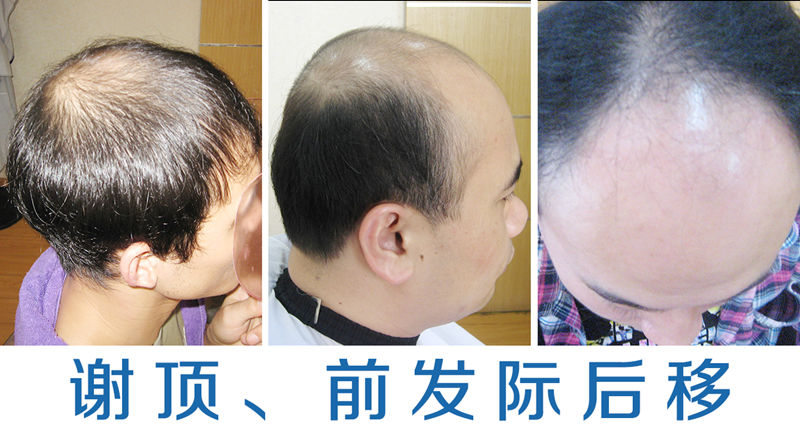 脱发男生如何快速密发