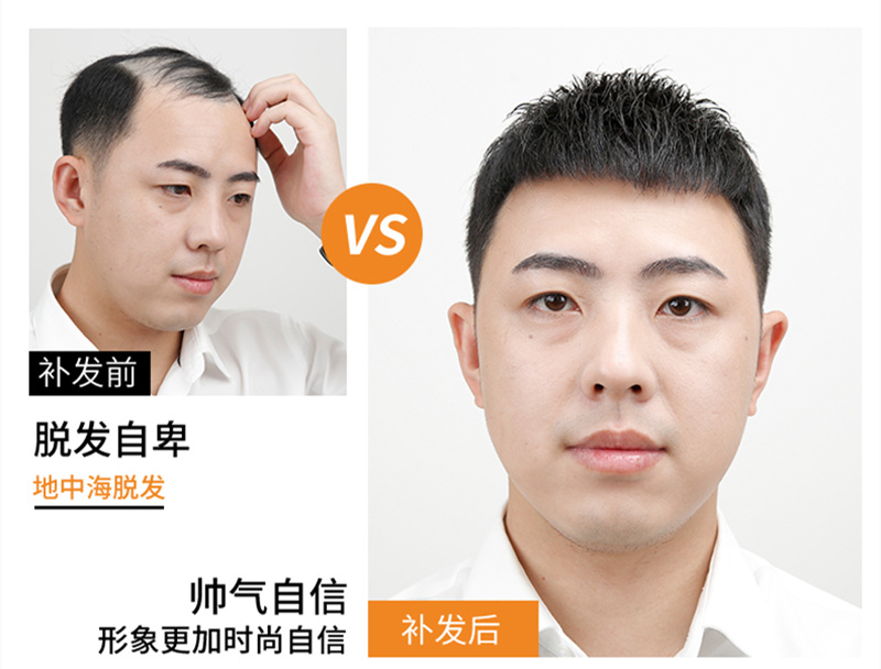 脱发男生如何快速密发