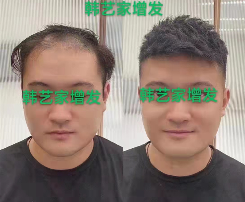 脱发男生如何快速密发
