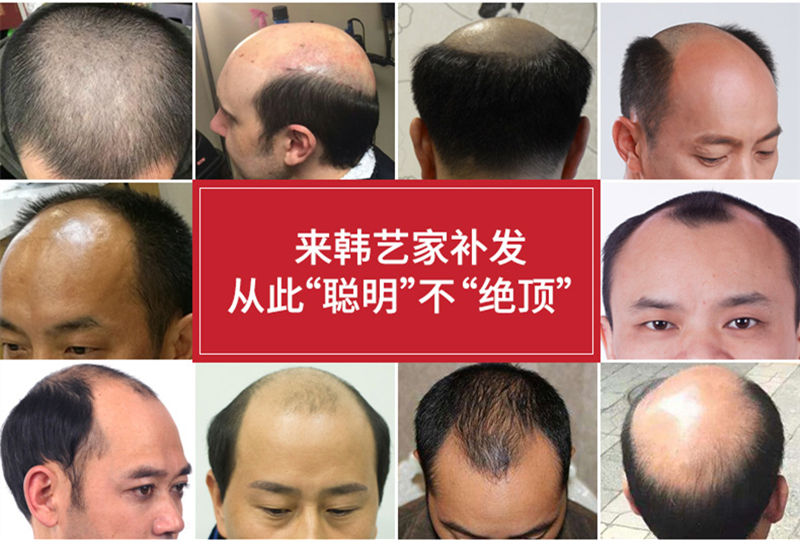 男人应该做隐形织发