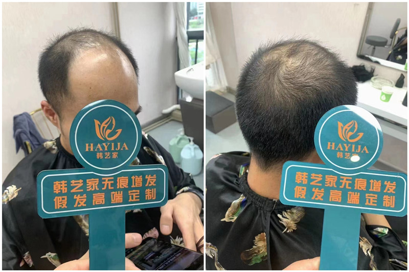韩艺家隐形补发效果