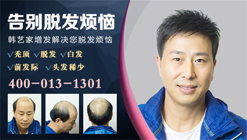男士戴假发片舒服吗