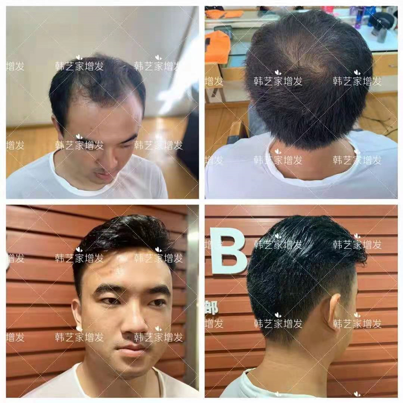 男士假发应该怎么选
