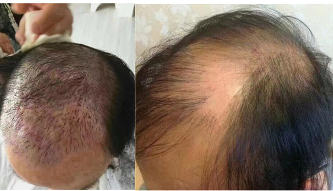 无痕假发补发