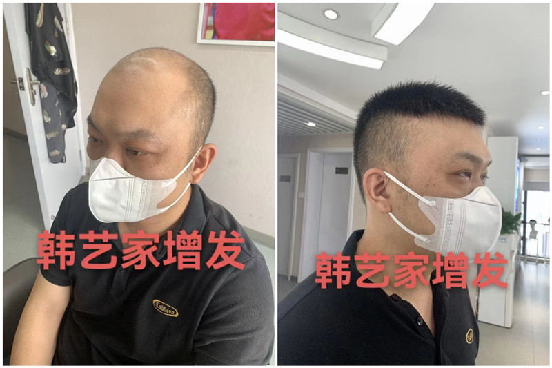 无痕假发补发