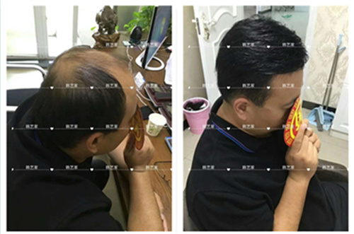 哪里补发好 韩艺家织发补发