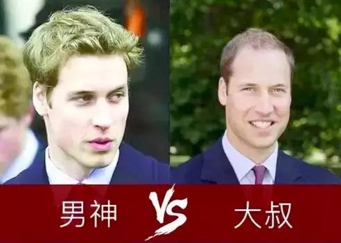 发际线 威廉王子脱发